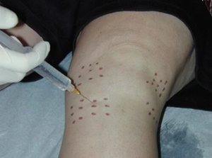 خشونة الركبة وعلاجها بتقنية البرولوثيرابي